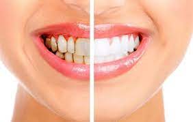 Teeth Whitening Clinic 
