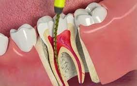 BEST ROOT CANAL TREATMENT CLINIC