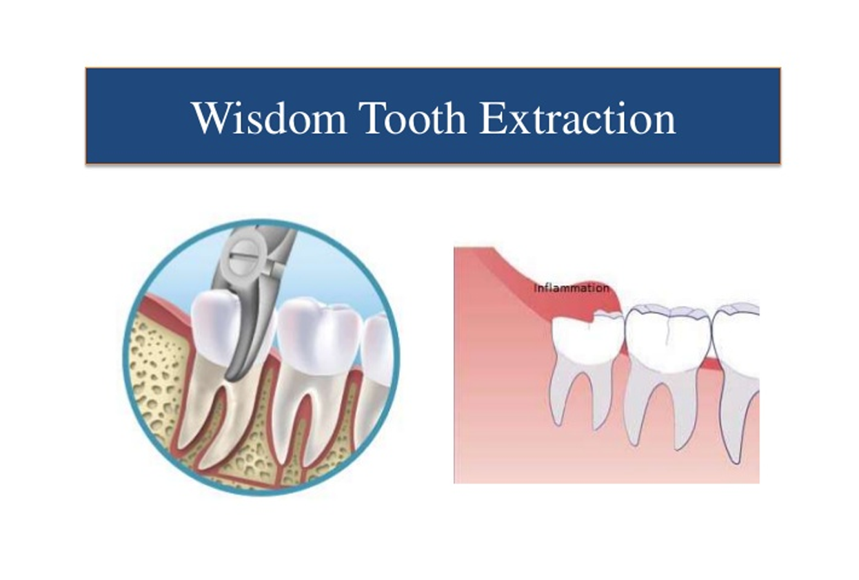 Surgical Wisdom Tooth Extraction