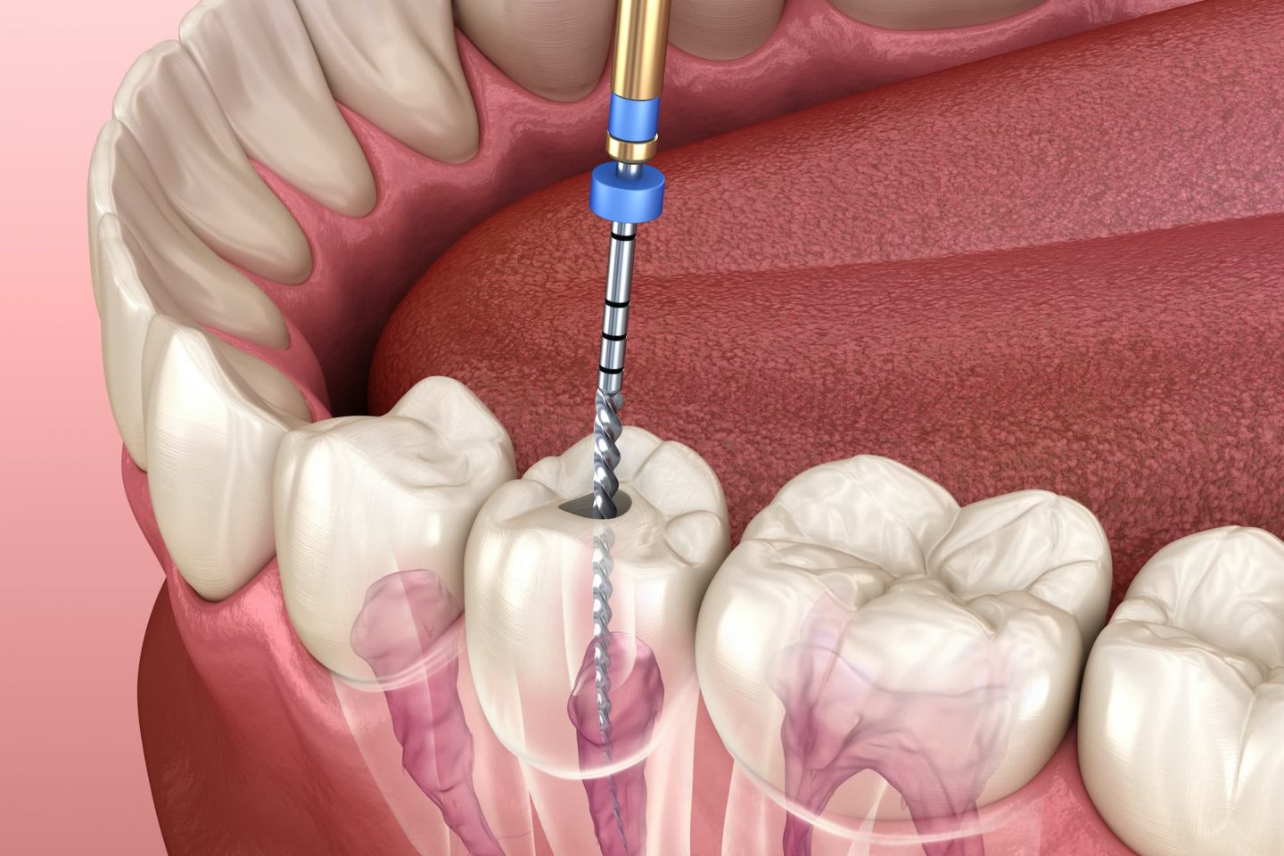 Best Root canal Treatment Clinic