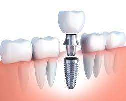 Best Dental implants