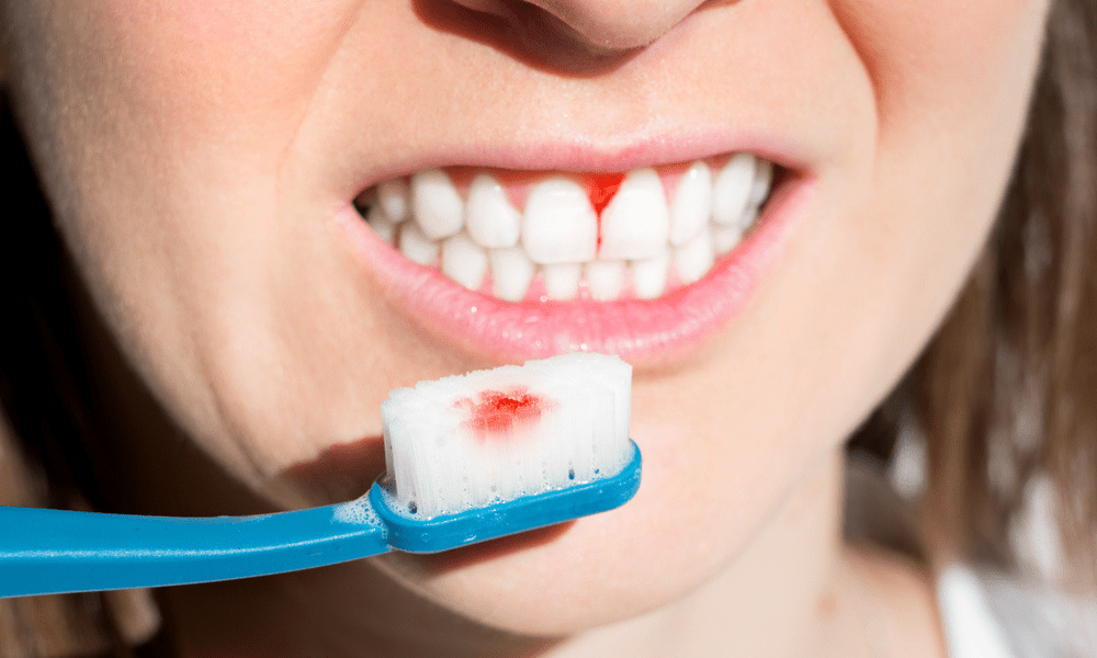 Gum Disease Cure